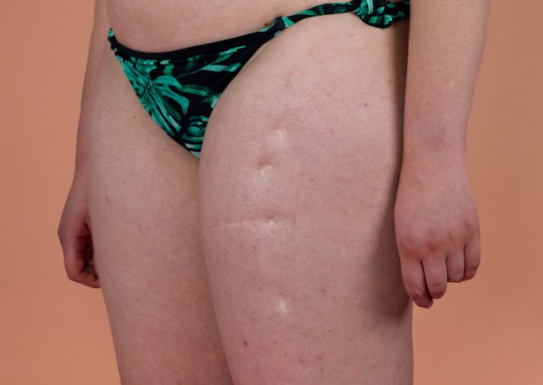 A photo of legs with scars from surgery. 3 round dimple scars and one long thin scar. Skin toned background BA Photography Jemma Bloomfield